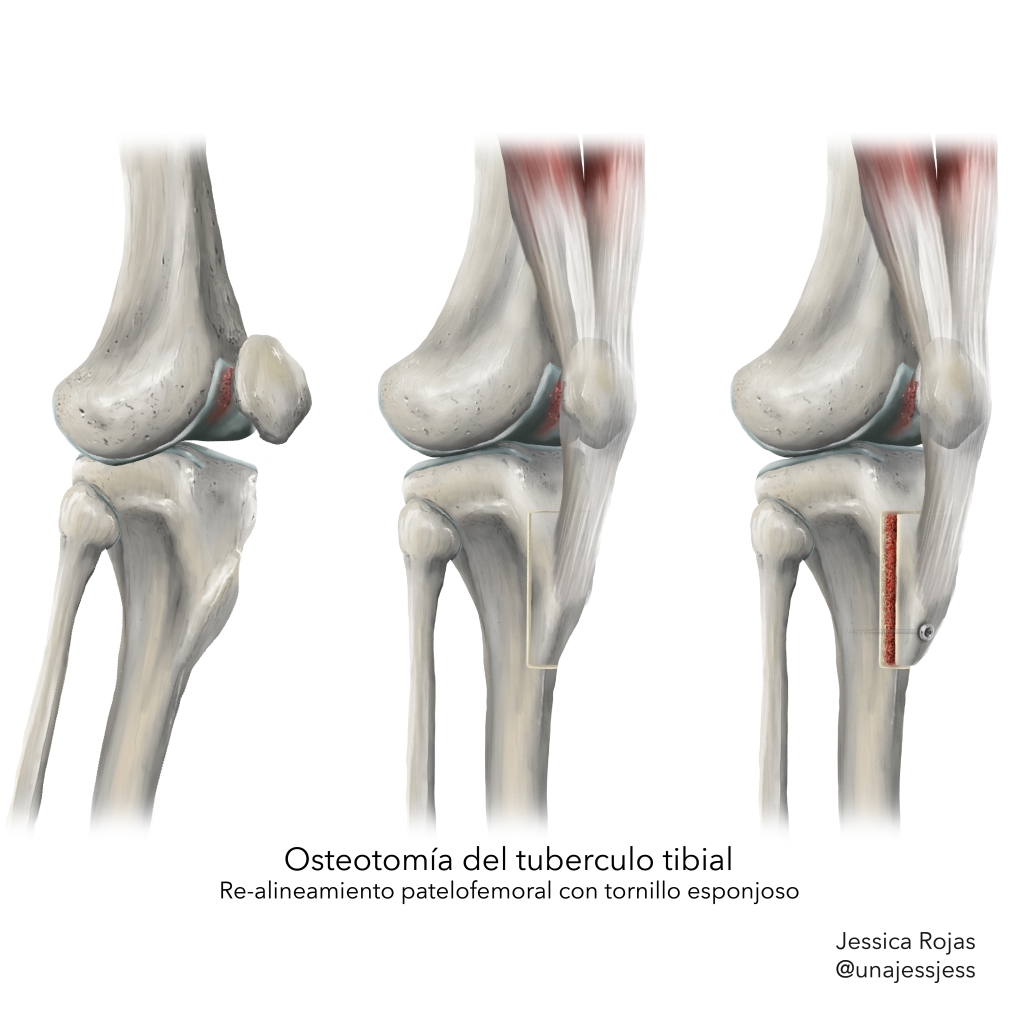 Osteomía del tubérculo tibial o realineamiento patelofemoral